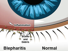 Load image into Gallery viewer, BLEPHEX®- BLEPHARITIS TREATMENT