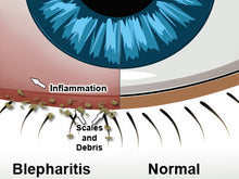 Load image into Gallery viewer, BLEPHEX®- BLEPHARITIS TREATMENT

